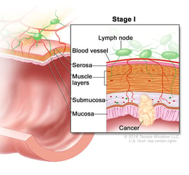 colorectal-ca-stage-1