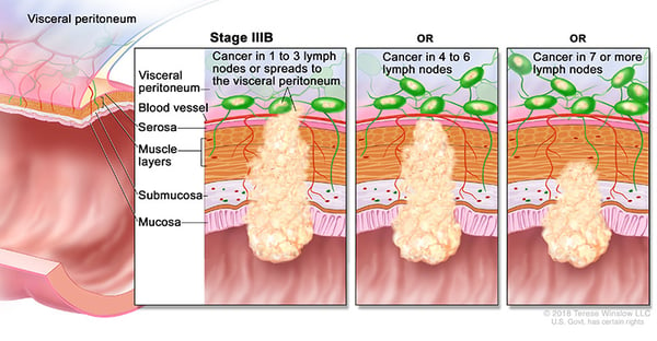 colorectal-ca-stage-3B