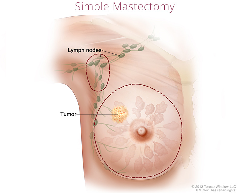 breast-total-simple-mastectomy