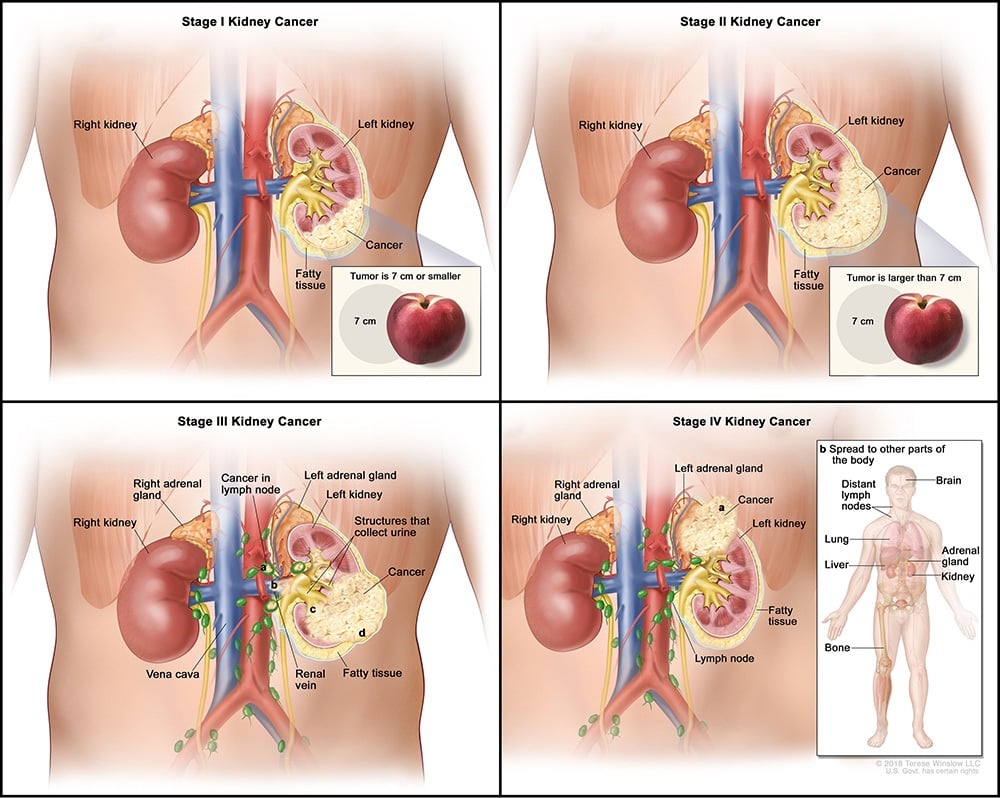 kidney cancer stages