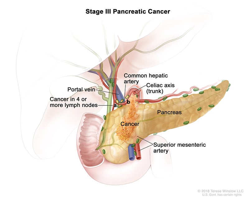 pancreatic-ca-stage-3