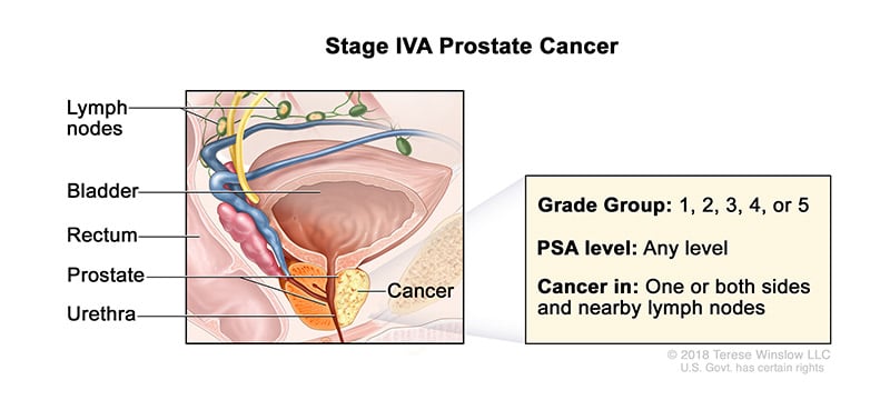 prostate-stage-4A